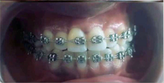 After Braces Treatment